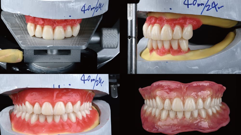 Artificial teeth arrangement and denture fabrication