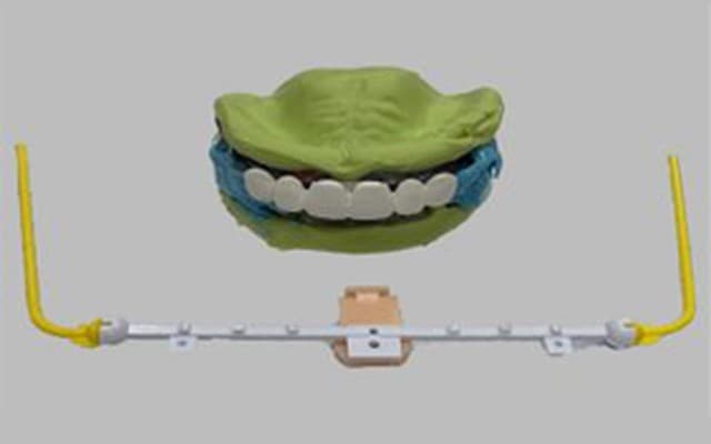 Definitive impression records with temporary denture