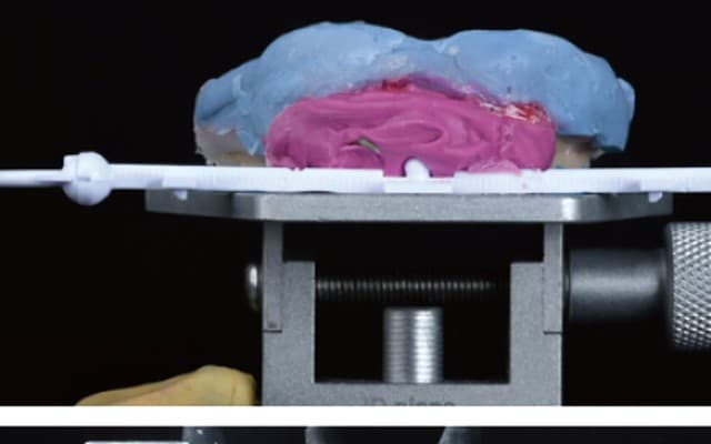 Definitive impression with wax rim on articulator