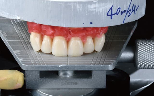 Temporary denture setup on articulator